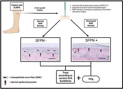 Small fiber polyneuropathy: A new therapeutic target in patients with interstitial cystitis/bladder pain syndrome?